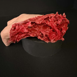 Lacerated Hand